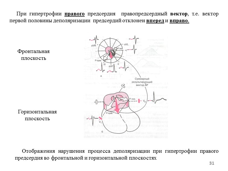 31 Отображения нарушения процесса деполяризации при гипертрофии правого предсердия 31 Отображения нарушения процесса деполяризации при гипертрофии правого предсердия